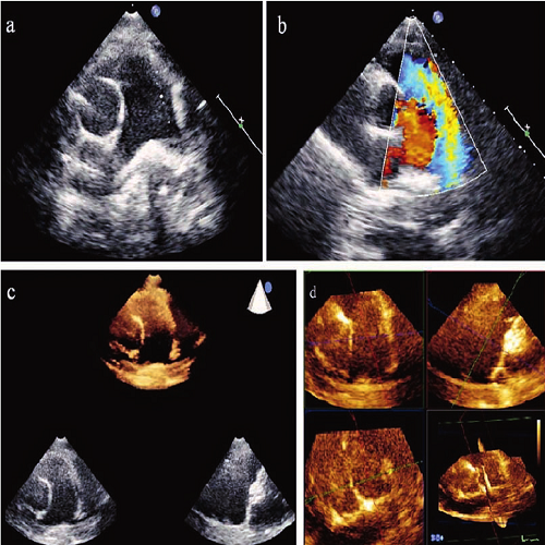 Echocardiography